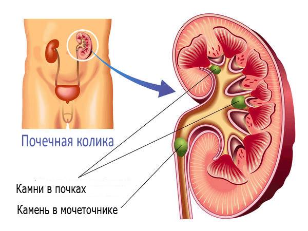 pochechnaya kolika
