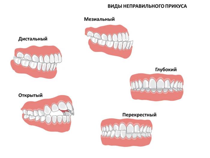 nepravilnyiy-prikus