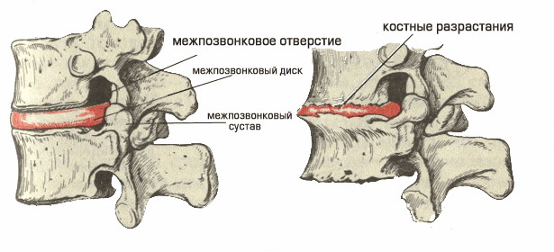 osteo_2