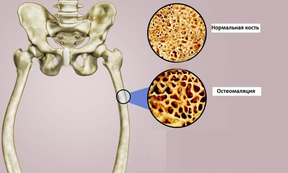 ostepmalasia