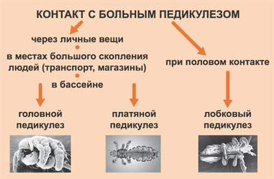 Виды педикулеза