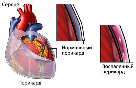 perikardit