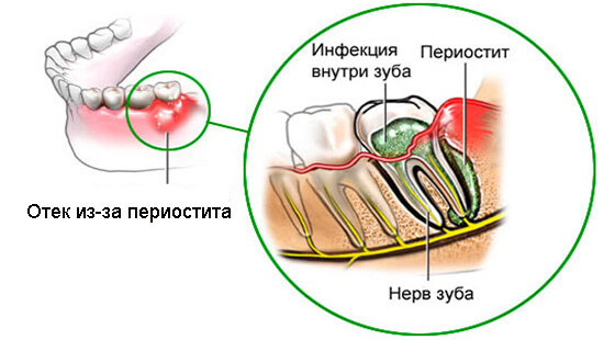 periostit