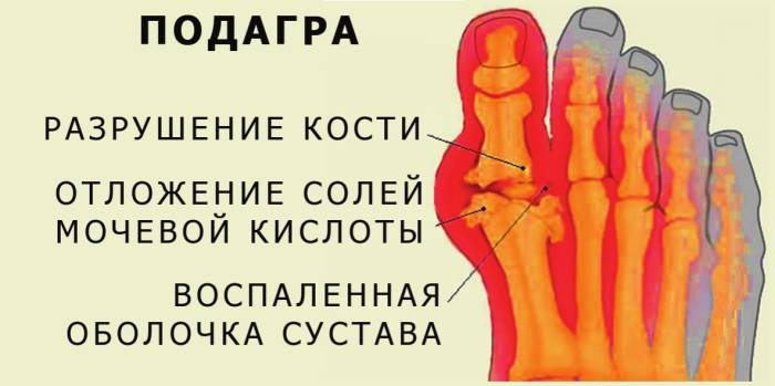 podagra
