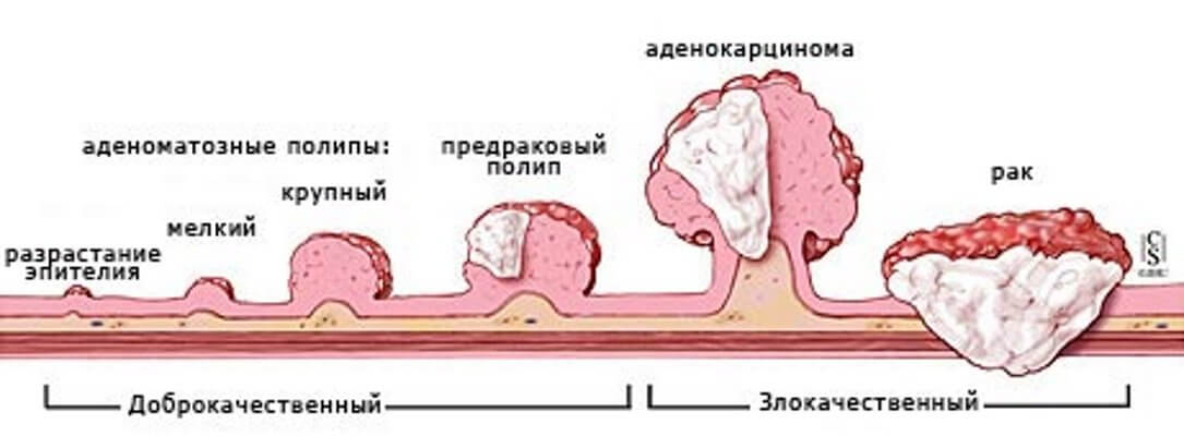 polipy-kishechnika