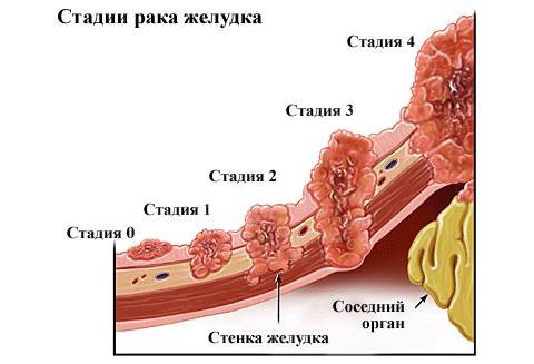 Стадия развития рака желудка