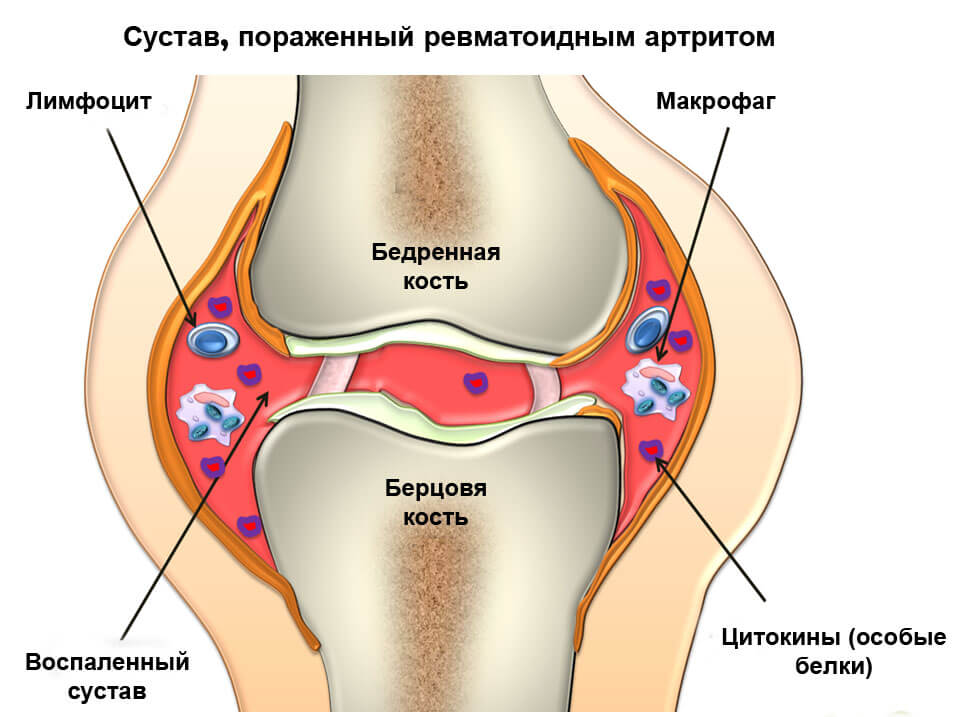 revmatoidnyiy_artrit