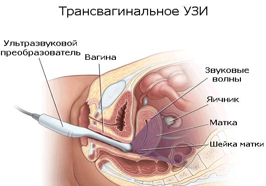 transvaginalnoe-uzi