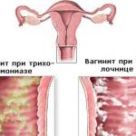 vaginit