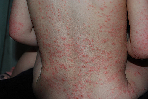 vidy_allergii_u_detej