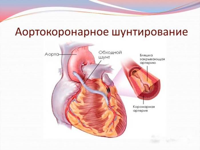 koronarnoe shuntirovanie