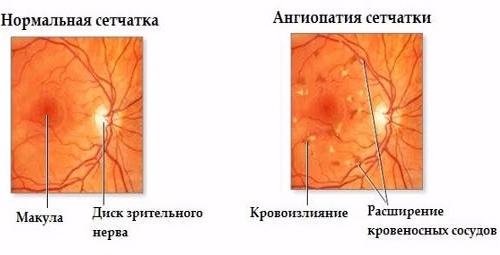 Ангиопатия сетчатки Ангиопатия сетчатки
