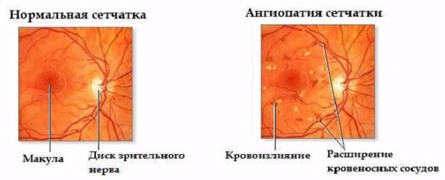 Атеросклеротическая ангиопатия Атеросклеротическая ангиопатия