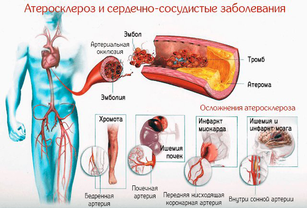 Атеросклероз и его осложнения Атеросклероз и его осложнения
