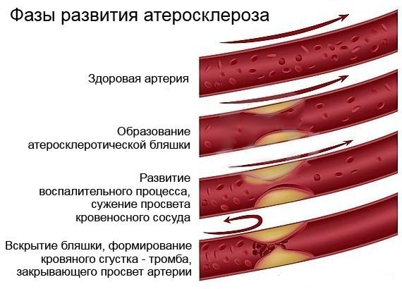 Фазы развития атеросклероза
