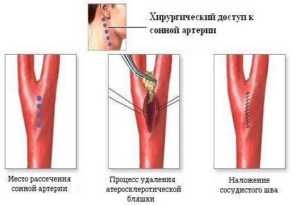 Хирургическое лечение артерий Хирургическое лечение артерий