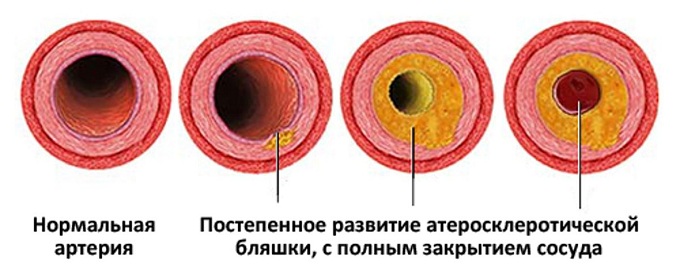 Холестериновые бляшки в сосудах Холестериновые бляшки в сосудах