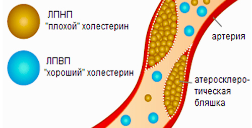 Хороший и плохой холестерин Хороший и плохой холестерин