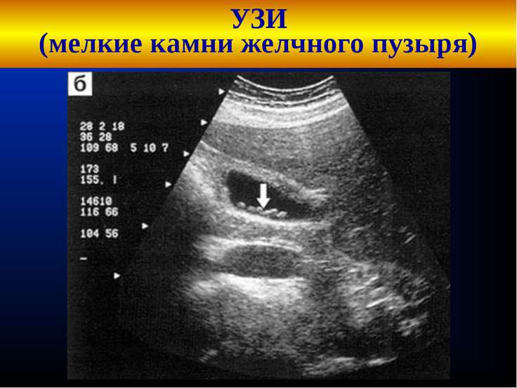 Камни на УЗИ Камни на УЗИ