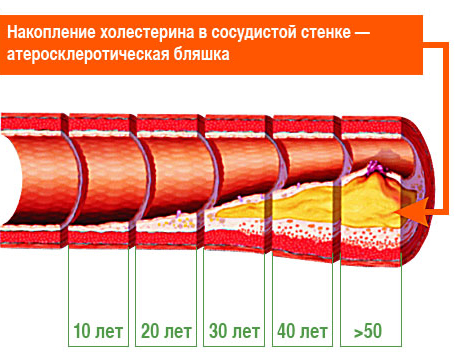 Накопление холестерина Накопление холестерина