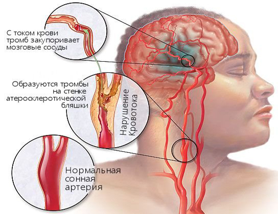 Развитие атеросклероза Развитие атеросклероза