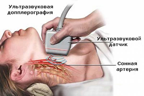 Схема УЗДГ сонной артерии Схема УЗДГ сонной артерии