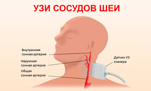 Схема УЗИ сосудов шеи