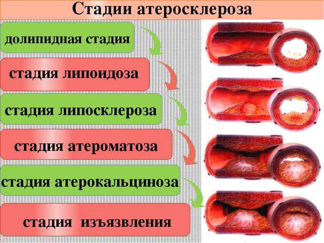 Стадии атеросклероза Стадии атеросклероза