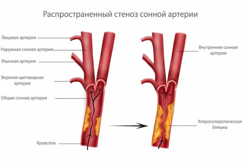 Стеноз сонной артерии Стеноз сонной артерии