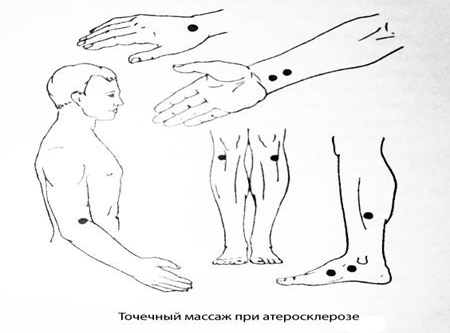 Точечный массаж при атеросклерозе Точечный массаж при атеросклерозе