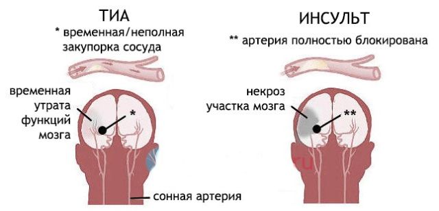 Транзиторные ишемические атаки Транзиторные ишемические атаки