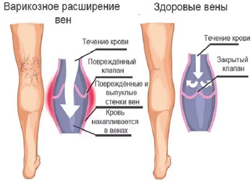 Варикозное расширение вен
