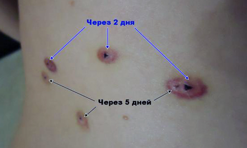 Заживление кожи после процедуры Заживление кожи после процедуры